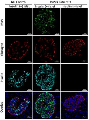 Detection of Antiviral Tissue Responses and Increased Cell Stress in the Pancreatic Islets of Newly Diagnosed Type 1 Diabetes Patients: Results From the DiViD Study